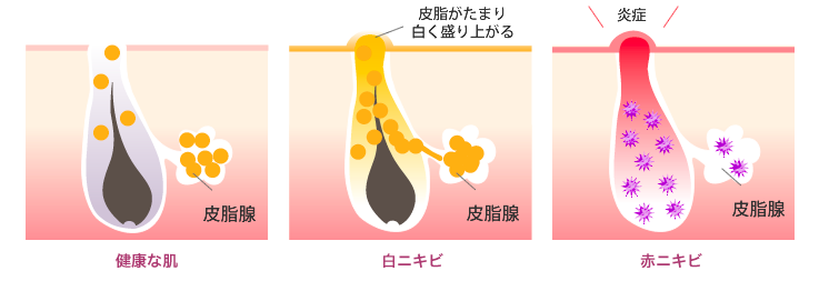 ニキビ ニキビ跡内服治療 きぬがさクリニック梅田院 きぬがさクリニック梅田院 公式 女医担当 婦人科形成 美容外科 皮膚科